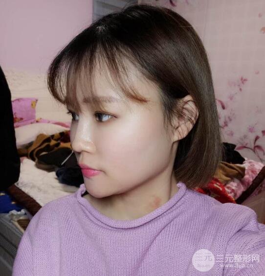 全臉脂肪填充價(jià)格 恢復(fù)過程圖 真實(shí)案例分享