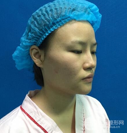 全臉脂肪填充價(jià)格 恢復(fù)過程圖 真實(shí)案例分享