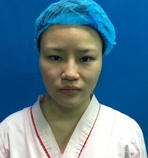 全臉脂肪填充價(jià)格 恢復(fù)過程圖 真實(shí)案例分享