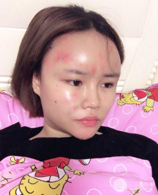 全臉脂肪填充價(jià)格 恢復(fù)過程圖 真實(shí)案例分享