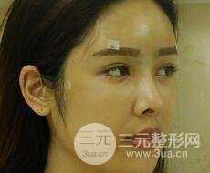 大腿抽脂做臉部脂肪填充 包括太陽穴和額頭價格果分享