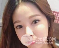 大腿抽脂做臉部脂肪填充 包括太陽穴和額頭價格果分享