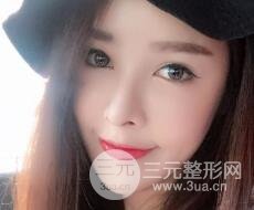 大腿抽脂做臉部脂肪填充 包括太陽穴和額頭價格果分享