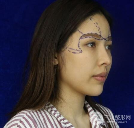 大腿抽脂做臉部脂肪填充 包括太陽(yáng)穴和額頭價(jià)格果分享