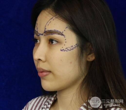 大腿抽脂做臉部脂肪填充 包括太陽(yáng)穴和額頭價(jià)格果分享