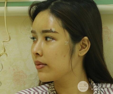 大腿抽脂做臉部脂肪填充 包括太陽(yáng)穴和額頭價(jià)格果分享