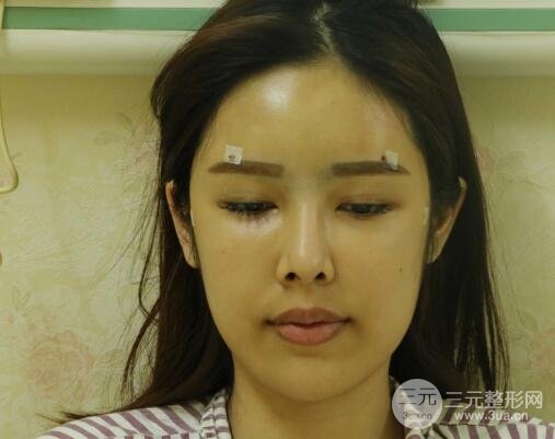 大腿抽脂做臉部脂肪填充 包括太陽(yáng)穴和額頭價(jià)格果分享