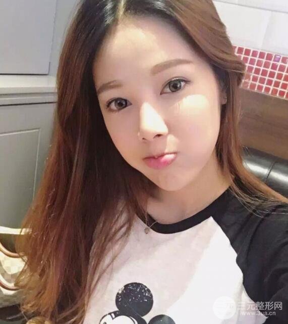 大腿抽脂做臉部脂肪填充 包括太陽(yáng)穴和額頭價(jià)格果分享