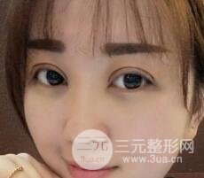 腫泡眼單眼皮變雙眼皮真實切開雙眼皮案例和對比圖