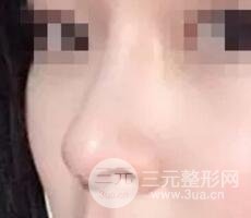 鼻子整形之駝峰鼻矯正價格和前后對比圖 真人案例