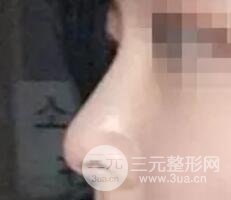 鼻子整形之駝峰鼻矯正價格和前后對比圖 真人案例
