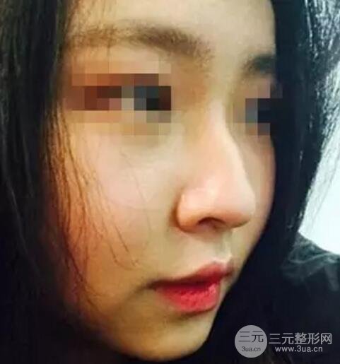 鼻子整形之駝峰鼻矯正價(jià)格和前后對(duì)比圖 真人案例