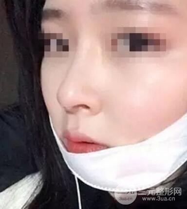 鼻子整形之駝峰鼻矯正價(jià)格和前后對(duì)比圖 真人案例