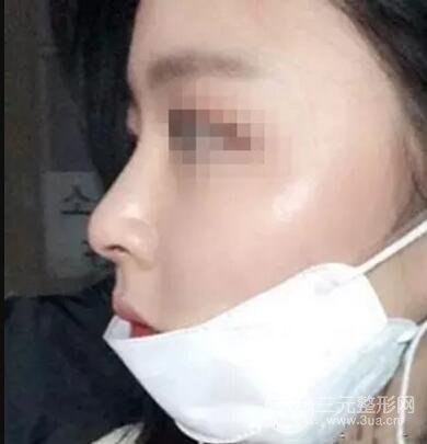 鼻子整形之駝峰鼻矯正價(jià)格和前后對(duì)比圖 真人案例