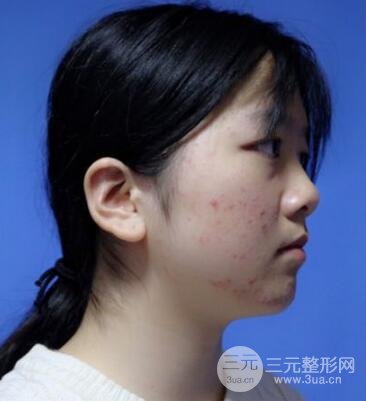 怎樣減掉雙下巴？雙下巴吸脂后個(gè)人經(jīng)歷 價(jià)格略貴但果好