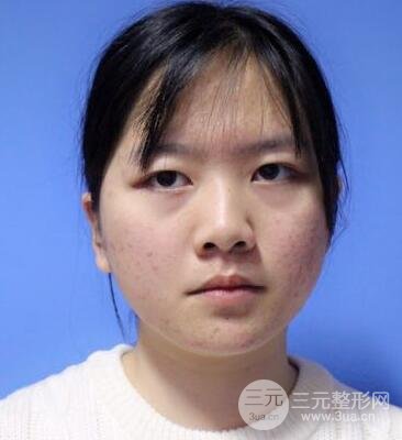 怎樣減掉雙下巴？雙下巴吸脂后個(gè)人經(jīng)歷 價(jià)格略貴但果好