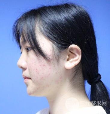 怎樣減掉雙下巴？雙下巴吸脂后個(gè)人經(jīng)歷 價(jià)格略貴但果好