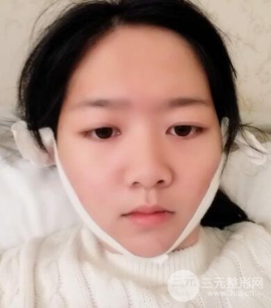 怎樣減掉雙下巴？雙下巴吸脂后個(gè)人經(jīng)歷 價(jià)格略貴但果好