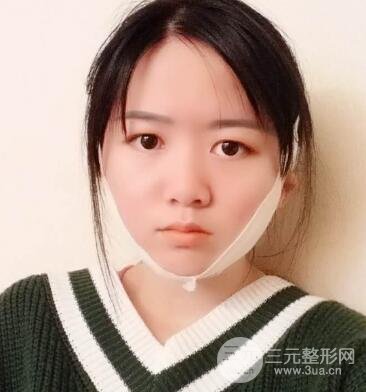 怎樣減掉雙下巴？雙下巴吸脂后個(gè)人經(jīng)歷 價(jià)格略貴但果好