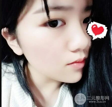 怎樣減掉雙下巴？雙下巴吸脂后個(gè)人經(jīng)歷 價(jià)格略貴但果好