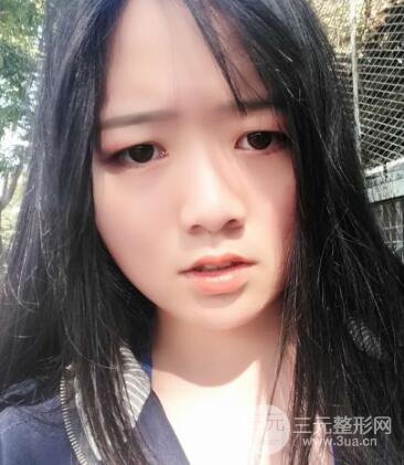 怎樣減掉雙下巴？雙下巴吸脂后個(gè)人經(jīng)歷 價(jià)格略貴但果好