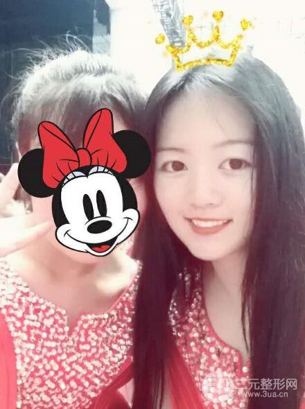 怎樣減掉雙下巴？雙下巴吸脂后個(gè)人經(jīng)歷 價(jià)格略貴但果好