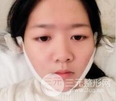 怎樣減掉雙下巴？雙下巴吸脂后個(gè)人經(jīng)歷 價(jià)格略貴但果好