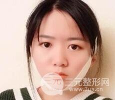 怎樣減掉雙下巴？雙下巴吸脂后個(gè)人經(jīng)歷 價(jià)格略貴但果好