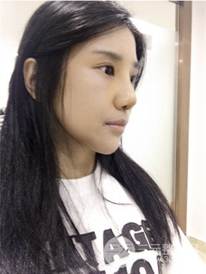 珠海萊茵門診部馬中衛(wèi)隆鼻整形案例分享，并附上前后對比照片~