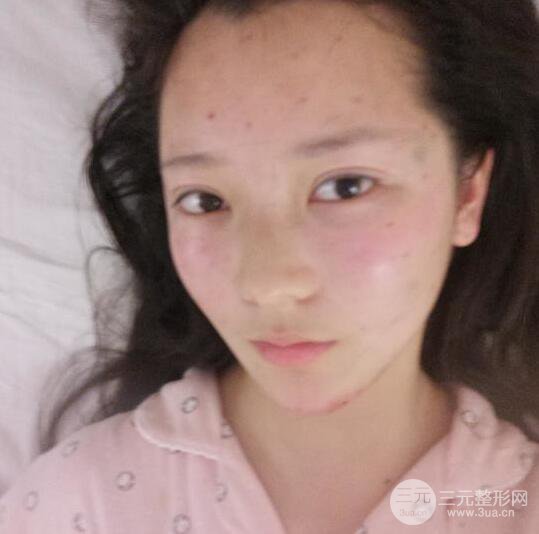 長(zhǎng)得太著急是怎樣一種體驗(yàn)？妹子血淚分享自體脂肪填充詳細(xì)部年輕化經(jīng)驗(yàn)