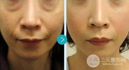 光子嫩膚多少錢一次？一般做幾次有果？