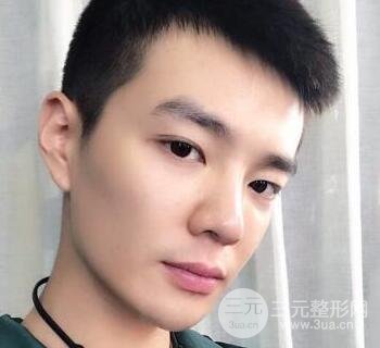 高強度聚焦超聲面b提升術(shù)多少錢?親身經(jīng)歷案例