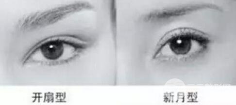 做歐式雙眼皮價(jià)格和需要滿足5個(gè)條件果才好