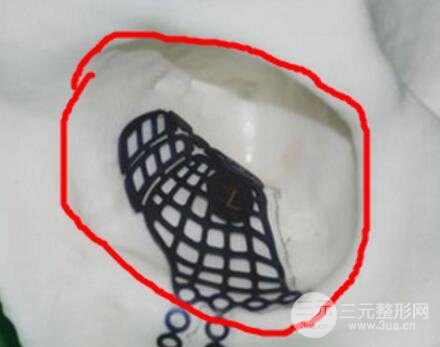 做歐式雙眼皮價(jià)格和需要滿足5個(gè)條件果才好