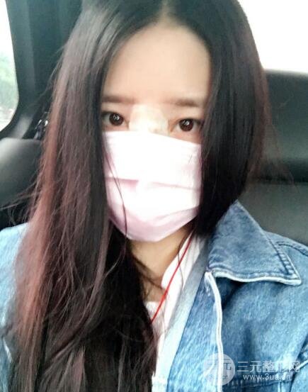 隆鼻整形包括假體隆鼻+耳軟骨墊鼻尖+鼻小柱延長