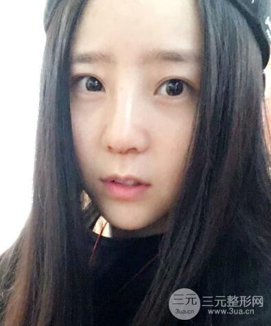 隆鼻整形包括假體隆鼻+耳軟骨墊鼻尖+鼻小柱延長