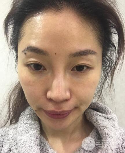 面b提升術(shù)多少錢?價格和案例分享