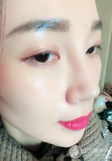 面b提升術(shù)多少錢?價格和案例分享