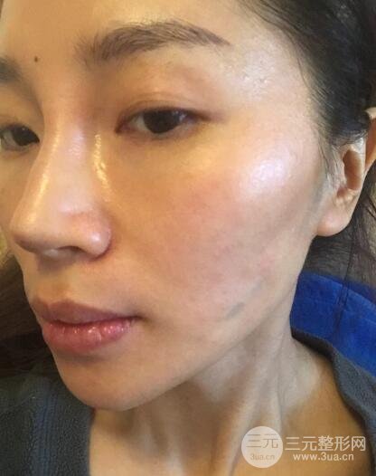 面b提升術(shù)多少錢?價格和案例分享