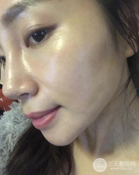 面b提升術(shù)多少錢?價格和案例分享