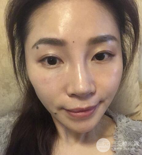 面b提升術(shù)多少錢?價格和案例分享