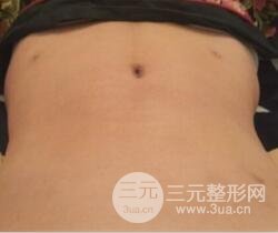 腹部抽脂價格和恢復(fù)案例