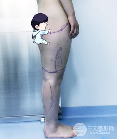 抽脂瘦腿價(jià)格和親身經(jīng)歷圖