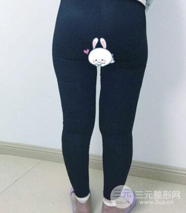 抽脂瘦腿價(jià)格和親身經(jīng)歷圖