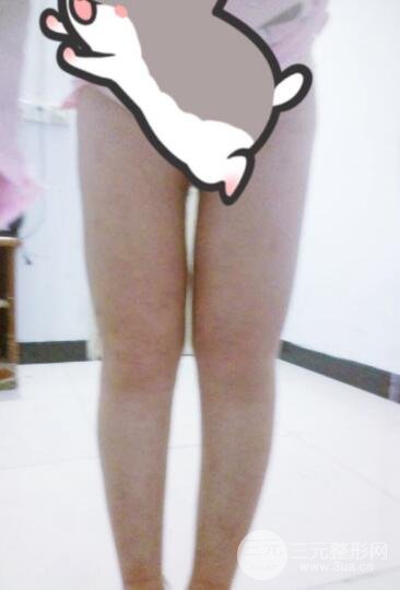 抽脂瘦腿價(jià)格和親身經(jīng)歷圖