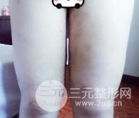 抽脂瘦腿價格和親身經(jīng)歷圖