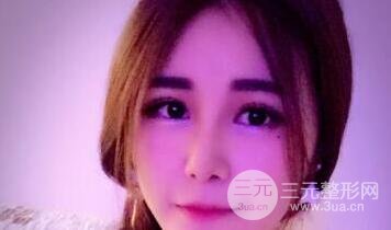 鼻子整形恢復(fù)過程真人案例