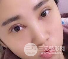 切開雙眼皮+開內(nèi)眼角案例