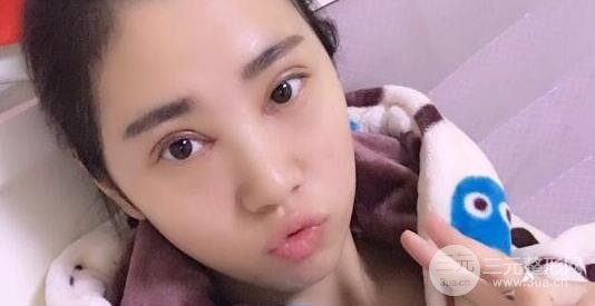 切開(kāi)雙眼皮+開(kāi)內(nèi)眼角案例