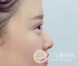 三點定位雙眼皮整形恢復(fù)圖案例